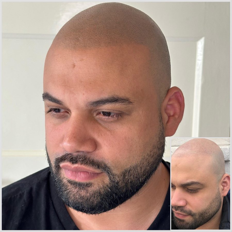 Voor en na resultaat Scalp Micropigmentatie